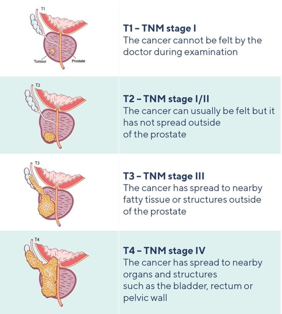 frontiers-personalized-medicine-for-prostate-cancer-is-targeting