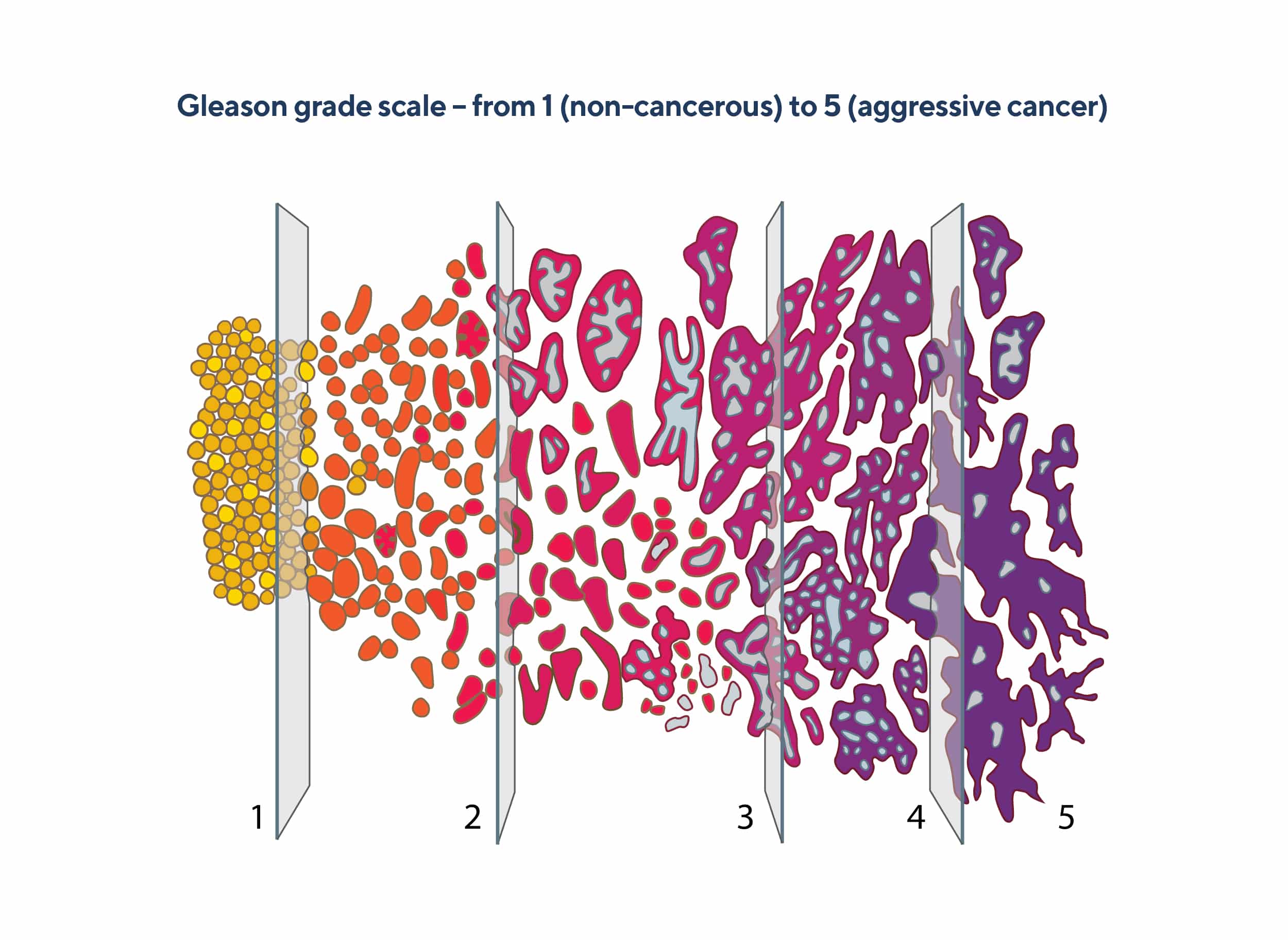 Your Gleason Score & ISUP Grade | PCFA